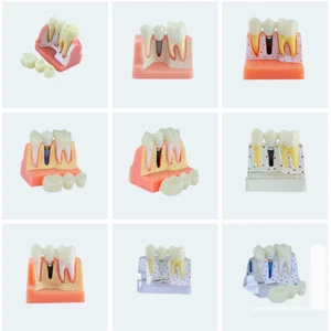 Implante Dental MODELO Demostración Dientes Extraíbles Modelo Análisis Corona Puente - Imagen 1 de 15