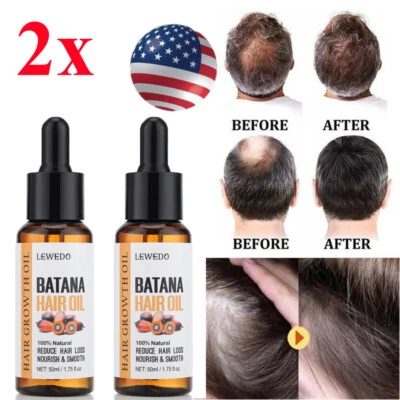 2Pcs Batana Oil Serum for Hair Growth, Batana Oil Organic, Repair Damaged Hair - Image 1 of 4