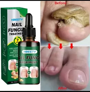7-Day Toenail Fungus Treatment – Extra Strength Repair for Discolored Nails 30ML - Picture 1 of 7