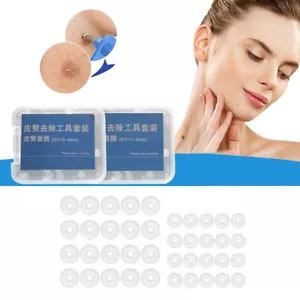 20Pcs Warts Rubber Ring 0.5/1/1.5MM Mole Wart Removal Wart Tool Replacement - Picture 1 of 14