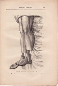 Alte medizinische Gravur 29 - Praktische Medizin - Gefrorene Füße Cas um 1871 - Bild 1 von 1