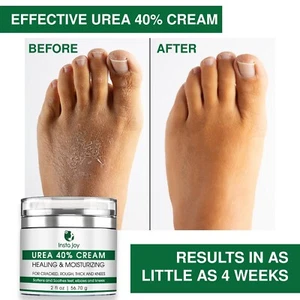 Urea Cream 40% with Salicylic Acid Crack Skin Repair Callus Feet Callus Remover - Picture 1 of 12