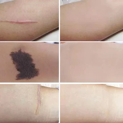 Tattoo Narben Concealer Aufkleber flach dünn hautfarben Abdeckband wasserdicht - Bild 1 von 4