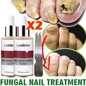 2Pcs Fungal Nail Repair Essence Serum+ Nail File Hand Feet Treatment Nail Repair - Picture 1 of 13