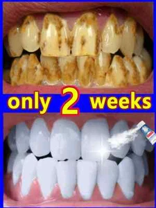Whitening and cleaning toothpaste, remove tartar, yellow teeth, bad breath - Picture 1 of 6