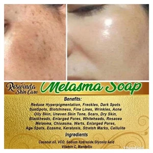 Whitening Melasma Soap Available Dark Sunspot Wrinkles Acne Blackheads Fine Line - Picture 1 of 11