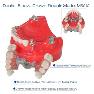 Accesorio de restauración dental modelo PRD corona telescópica demostración dentadura base metálica - Imagen 1 de 8