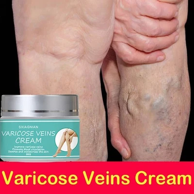 SXIAGNIAN VARICOSE VEINS TREATMENT CREAM VASCULITIS PHLEBITIS SPIDER VEINS Relief Gel 50G
