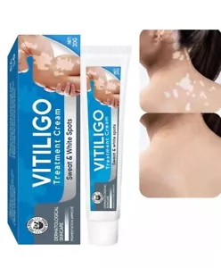 Vitiligo Treatment Vitiligo Cream Improve Skin Pigmentation Reduces White Spots - Picture 1 of 1