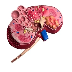Kidney Model Dissected Diseased Human Anatomical Medical Pathological Changes - Picture 1 of 10