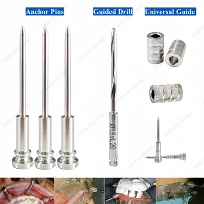 Herramienta de fijación de plantilla de implante guiado taladro guiado pasador de anclaje dental ⌀1,5 Foto 1 de 4