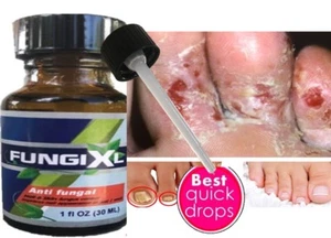 Nail Fungal Antifungal Nails Support Anti Fungus Toe Hongos En Uñas los Pies - Picture 1 of 5