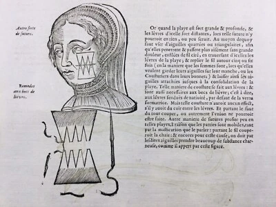 Chirurgie Esthétique Chirurgie du Visage 1585 Docteur Houllier Gravure Médecine - Photo 1/4