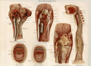 Tablero de colores ENFERMEDADES DEL CUELLO / DIFTERITIS / TUBERCULOSIS 1889 Litografía Original - Imagen 1 de 1