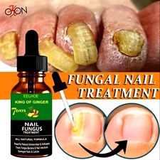 Foot Nail Fungus Treatment Serum AniFungs Ginger Foot Care Onychomycosis Removal