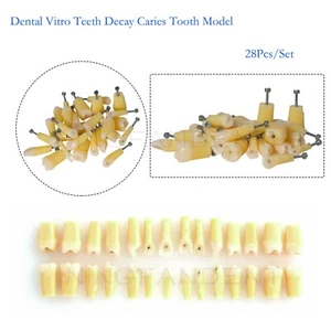 Kilgore Nissin Dental Vitro Dientes Caries Dientes Modelo Dentista Práctica R-28 - Imagen 1 de 26