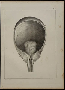 1839 - Tavola Di Anatomia E Urologia - Luette Vescicale E Prostata - LITOTRISSIA - Picture 1 of 3