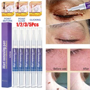 10/5Stk Warzen Entfernung Haut Tag Behandlung Creme Wart Remover Warze Entferner - Bild 1 von 22