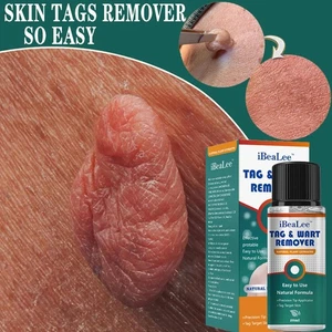 20ml Mole Warts Remover Liquid Best G2S4 - Picture 1 of 11