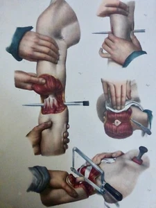 1850 ANATOMIE CHIRURGIE Amputation du bras 1 LITHOGRAPHIE - Imagen 1 de 3