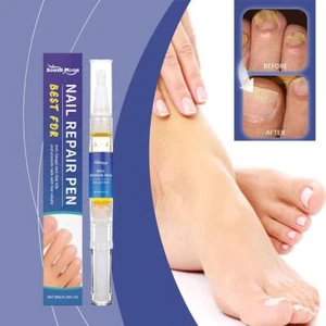 Fungal Nail Treatment Strong Fungus Remover Antifungal Liquid Serum Paronychia ≥ - Picture 1 of 18