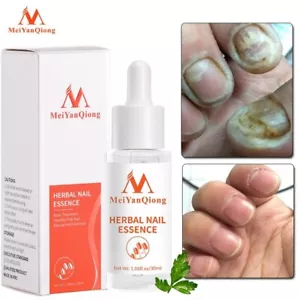 Nail Treatment Essence Serum Care Hand & Foot Nail Fungus Treatment Essence  - Picture 1 of 5