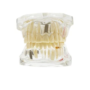 Transparent Dental Implant Teeth Model Removable Pathological Teaching Model - Picture 1 of 106