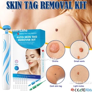 2in1 Micro Skin Tag-Entferner Device Kit schmerzlose Entfernung Bänder Werkzeug - Bild 1 von 17