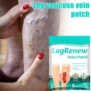 Parche para venas varicosas, parche profesional para tratamiento de venas varicosas en piernas BXH - Imagen 1 de 13