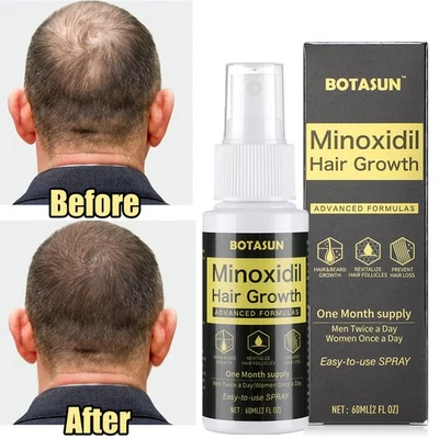BOTASUN Minoxidil 5% Hair Growth Serum Spray for Men Hair Loss Treatment 1 Month Supply