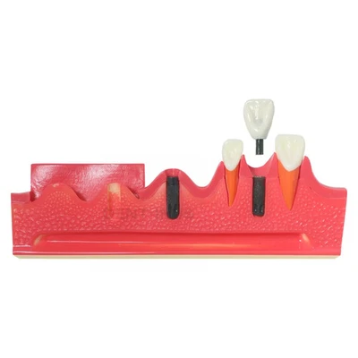 Implant Dental Model Tooth Show the Tooth Implant Process and Progress for Study - Image 1 of 4