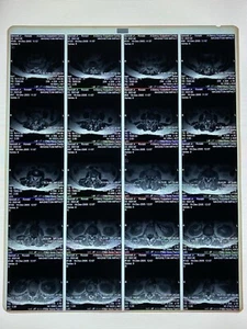 Röntgenfilm, Röntgen, gebraucht, Kurios, Medizinisch, Chirurgisch, Beerdigung - 14 x 17 MRT - WIRBELSÄULE - Bild 1 von 2