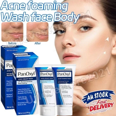 Moisture Benzoyl Peroxide 10% Foaming Acne Wash Skin Care 4% Daily Control Cream - image 1 of 4