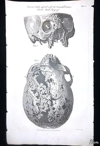 Antique engraving HUMAN SKULL W/ SYPHILIS anatomical medical art 1790s death STD - Picture 1 of 3