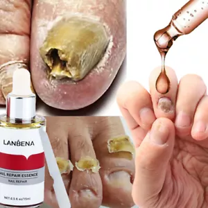 LANBENA Nail Repair Essence Oil Remove Onychomycosis Serum Fungal Nail Treatment - Picture 1 of 22