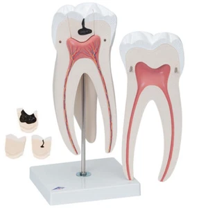 3B Scientific Giant Molar with Dental Cavities Human Tooth Models 6 Part Dentist - Picture 1 of 6