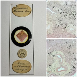 Diapositiva de microscopio antigua. Pulmón humano enfermo por barrido de chimenea. Por Watson. - Imagen 1 de 3