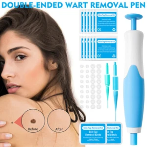 Auto Micro Skin Tag Remover Device Kit Safe Painless Removal 2-8 mm Band Tool USA - Bild 1 von 11