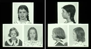 1920s Dental Anomalies Lantern Slides (2) Three Young Girls Front & Side Views - Picture 1 of 7