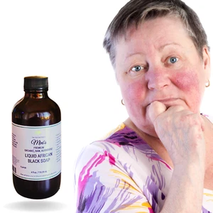 Fra Fra's Mini's | Premium EXTREME Healing Rosacea Liquid Black Soap Blend 4 oz - Picture 1 of 4