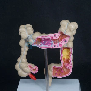 Anatomical Human Colon Intestine Pathological Diseases Model Medical Anatomy - Picture 1 of 4