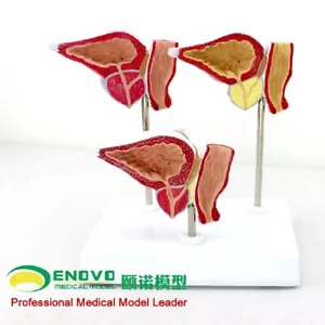 Modelo anatómico médico genitourinario normal y enferma glándula prostática - Imagen 1 de 12