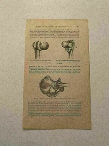 KP202) Unione Impacted Extracapsulare Frattura Femore Medico 229 1878 Incisione - Foto 1 di 1