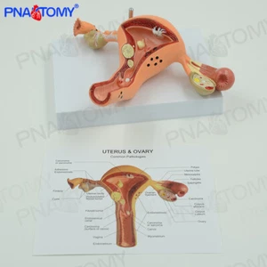 Female Diseased Uterus and Ovary Show Common Pathologies Anatomy Models - Picture 1 of 4
