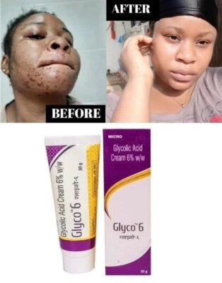 GLYCO 6 Glycolic Acid Cream 6% 30gms Pack BY Microlabs + FS - Image 1 of 4