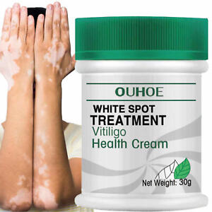 30g White Spot Cream Antibacterial Pigment Vitiligo Treatment Leukoplakia Relief