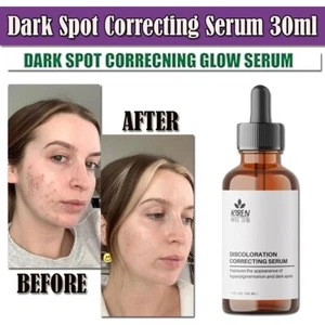 Age Spot, Sun Spot, Dark Spot Remover, Solution, Corrector, Treatment Serum 30ml - Picture 1 of 8