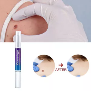 12 Stunden Warzenentferner flüssiger Stift 3ml Hautanhängsel Entferner beseitigt Fuß Hühneraugenwarzen - Bild 1 von 12