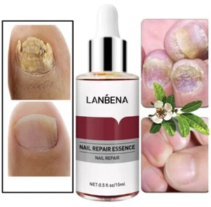 Anti Fungal Nail Treatment fungu Nail Finger Toe Fungus Onychomycosis Remover - Picture 1 of 15