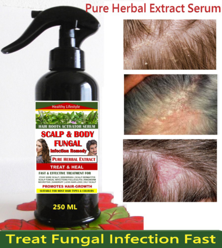 TREATMENT LICHEN PLANUS SCALP SEBORRHEIC DERMATITIS - HERBAL EXTRACT 250ML